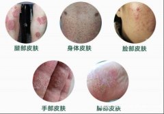 一到夏天，身体皮肤又痒又痛？别担心，这个神器来了